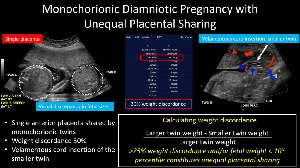 US Evaluation of Twin Pregnancies – Radiology.World